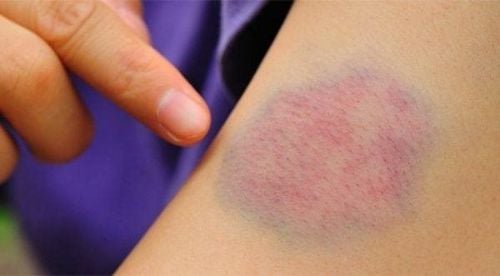 Bruising under the skin can result from minor bumps or car accidents