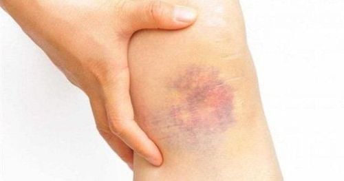 Many studies indicate that blood disorders can cause bruising under the skin.