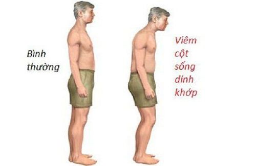 Bệnh viêm cột sống dính khớp gây ra nhiều hệ lụy nguy hiểm