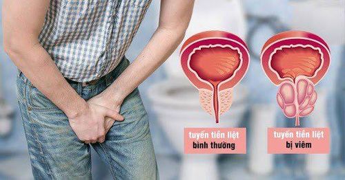 Rối loạn tuyến tiền liệt có thể khiến bạn gặp tình trạng xuất tinh bị đau