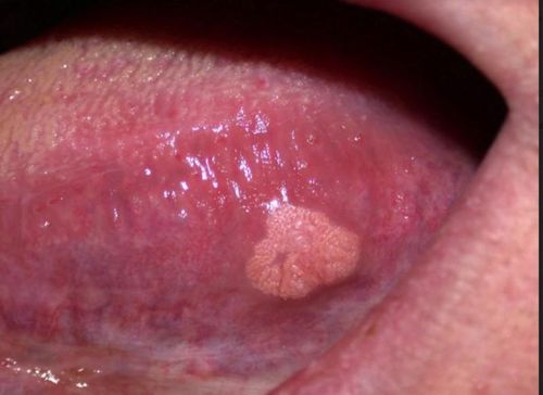 Phân biệt bệnh sùi mào gà ở miệng và nhiệt miệng