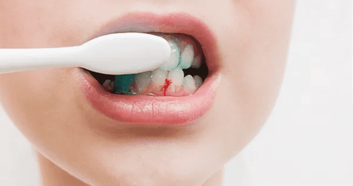 
Chảy máu khi đánh răng do nhiều nguyên nhân gây ra
