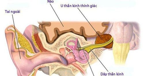 Acoustic neuroma may cause tinnitus.