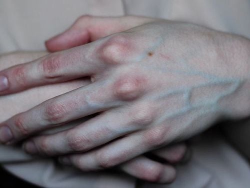 Is swollen blood vessels in the hand dangerous?