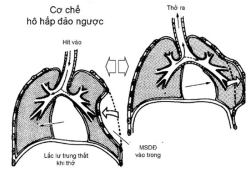 Paradoxical breathing is illustrated in the diagram.