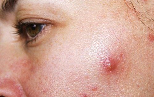 Distinguishing between common pimples and skin cancer