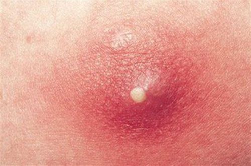 It is possible to distinguish between boils on the skin and boils that warn of the risk of cancer