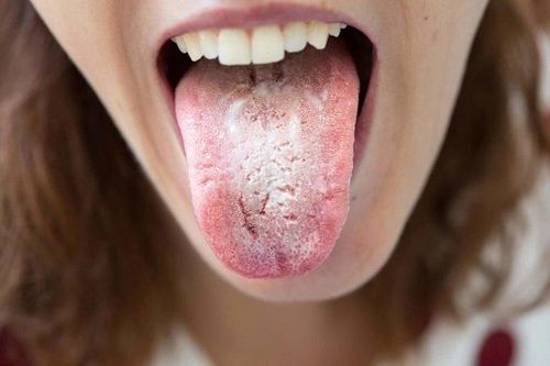 
A bad odor on the tongue is often the result of food fermentation by anaerobic gram-negative bacteria in the mouth.
