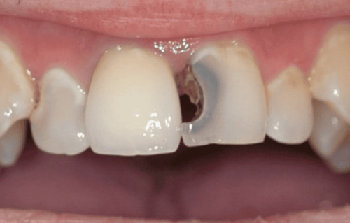 Trám răng cửa sâu có bền không?
