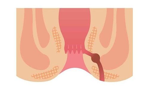 Is there a way to treat anal fistula at home?