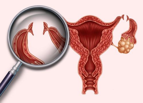 Có thể mang thai sau thắt buồng trứng không?