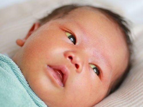 Trẻ sơ sinh vàng da mắt kèm vàng mắt có sao không?