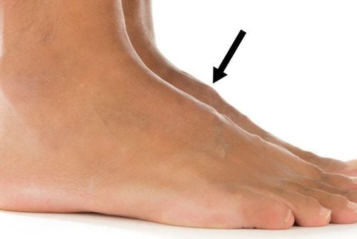 Sưng mu bàn chân do bong gân phải làm gì để nhanh khỏi?