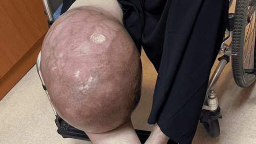 A Protector of Hope for Children with Bone Cance