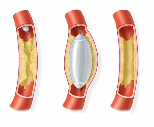 Tìm hiểu về bệnh động mạch vành