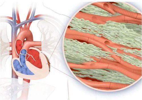 
Tình trạng thoái hoá dạng bột sẽ khiến cơ tim cứng hơn và mất đàn hồi
