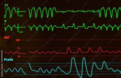 
Bệnh tim thoái hóa dạng bột có thể gây ra tình trạng rối loạn nhịp tim
