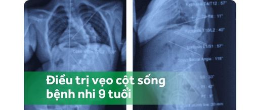 Vinmec Central Park điều trị thành công bệnh nhi 9 tuổi vẹo cột sống 100 độ nghiêm trọng