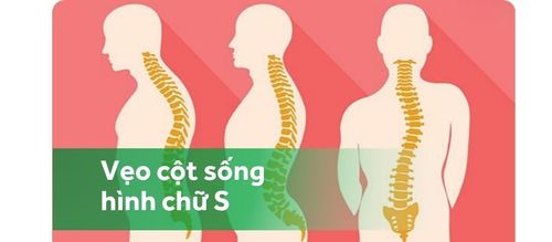 Cong vẹo cột sống hình chữ S có thể ảnh hưởng lên khung xương mặt không?