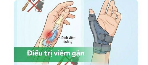 Điều trị viêm gân vùng mỏm trâm quay cổ tay