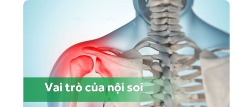 Vai trò của nội soi trong chẩn đoán và điều trị các bệnh về khớp vai