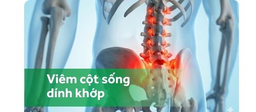 Viêm cột sống dính khớp có di truyền không?