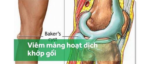 Tìm hiểu về bệnh viêm màng hoạt dịch khớp gối mạn tính không đặc hiệu