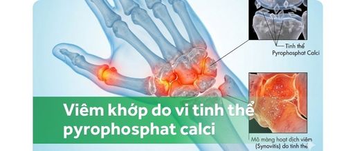 Tổng quan về bệnh viêm khớp do vi tinh thể pyrophosphat calci