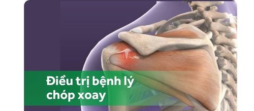 Phẫu thuật nội soi điều trị bệnh lý chóp xoay