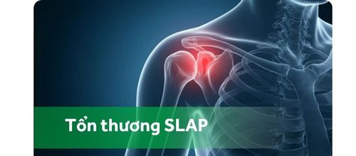 Tổn thương SLAP - Một nguyên nhân gây đau vai hay gặp trong thể thao