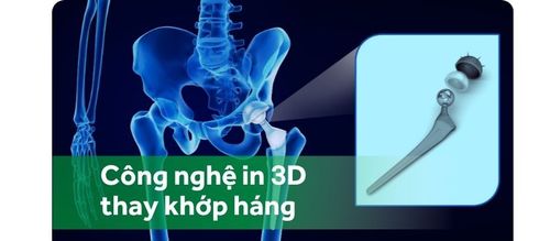 Phẫu thuật thay khớp háng cá thể hóa bằng công nghệ in 3D