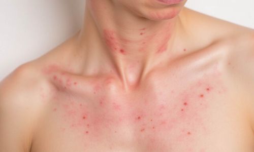 Bệnh lý đi kèm bệnh chàm và những thông tin cần biết