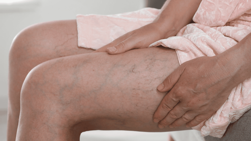 Bệnh co giãn tĩnh động mạch có thể chữa được không?