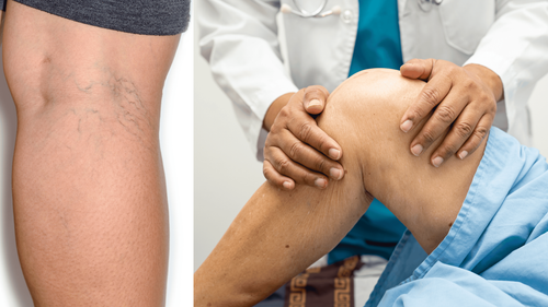 Bệnh lý suy tĩnh mạch và các biện pháp điều trị