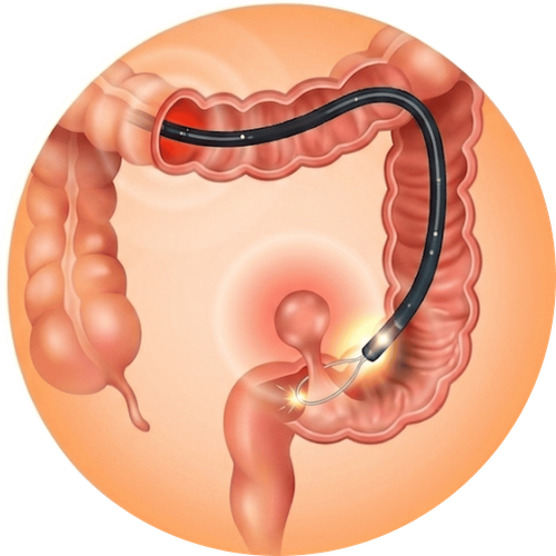 Cắt polyp tiêu hóa