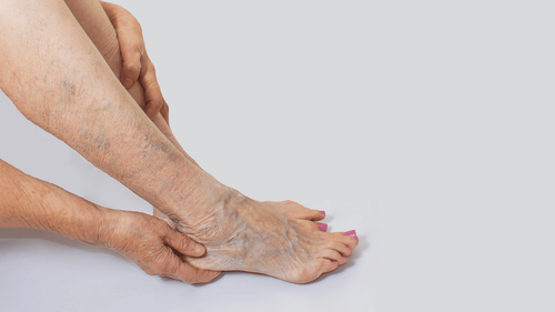 Chẩn đoán và điều trị suy giãn tĩnh mạch chi dưới mãn tính