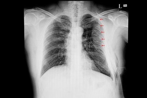 Among traumatic injuries, rib fractures are the most common and require treatment, affecting approximately 85% of patients.