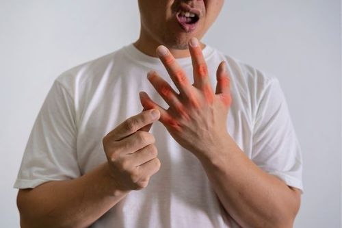 Gout symptoms usually present in a single joint