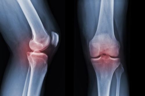 X-rays can detect fractures, dislocations, osteoarthritis, bone tumors