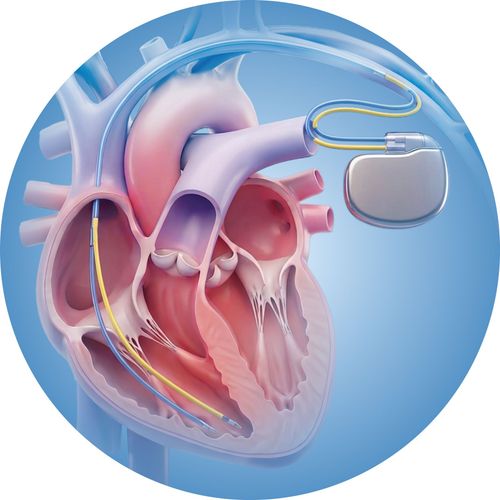 Rối loạn nhịp tim
