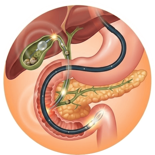 Nội soi mật tụy (ERCP)