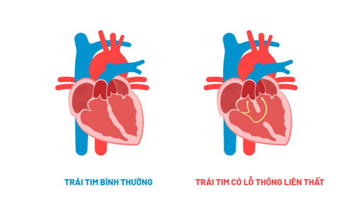 Thông liên thất là bệnh gì, có di truyền không và có nguy hiểm không?