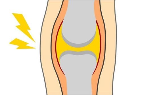 Why do joints make cracking sounds?