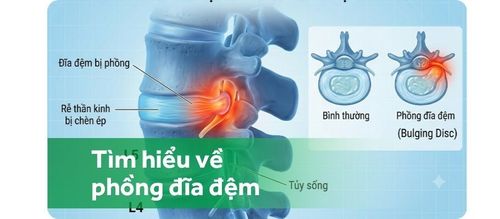 Phồng đĩa đệm có thể dẫn tới thoát vị đĩa đệm
