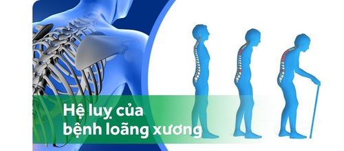 Loãng xương: Diễn biến âm thần, hậu quả nặng nề