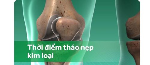 Sau phẫu thuật gãy xương bánh chè đầu gối có thể tháo kẹp kim loại?