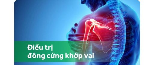 Điều trị đông cứng khớp vai gân cơ trên vai và đầu dài nhị vai không đồng đều như thế nào?