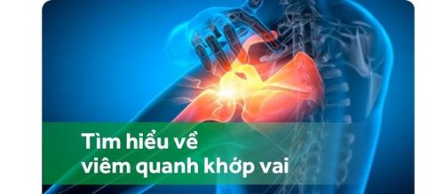 Nhận diện các thể viêm quanh khớp vai và triệu chứng đi kèm