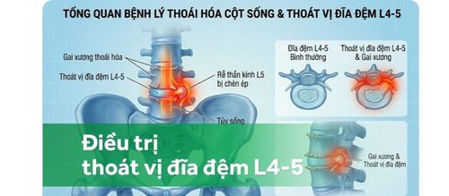 Điều trị thoái hóa cột sống và thoát vị đĩa đệm L4-5 như thế nào?