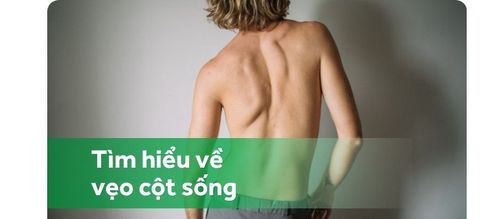 Vẹo cột sống: Những điều cần biết